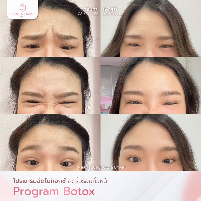 รีวิว Botox