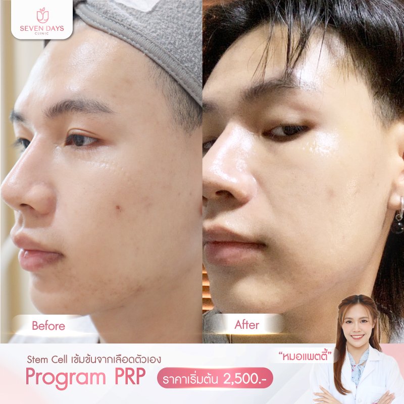 รีวิว PRP