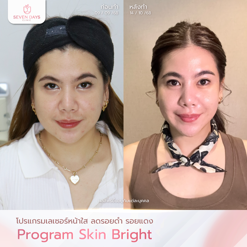 รีวิวโปรแกรม  Skin Bright
