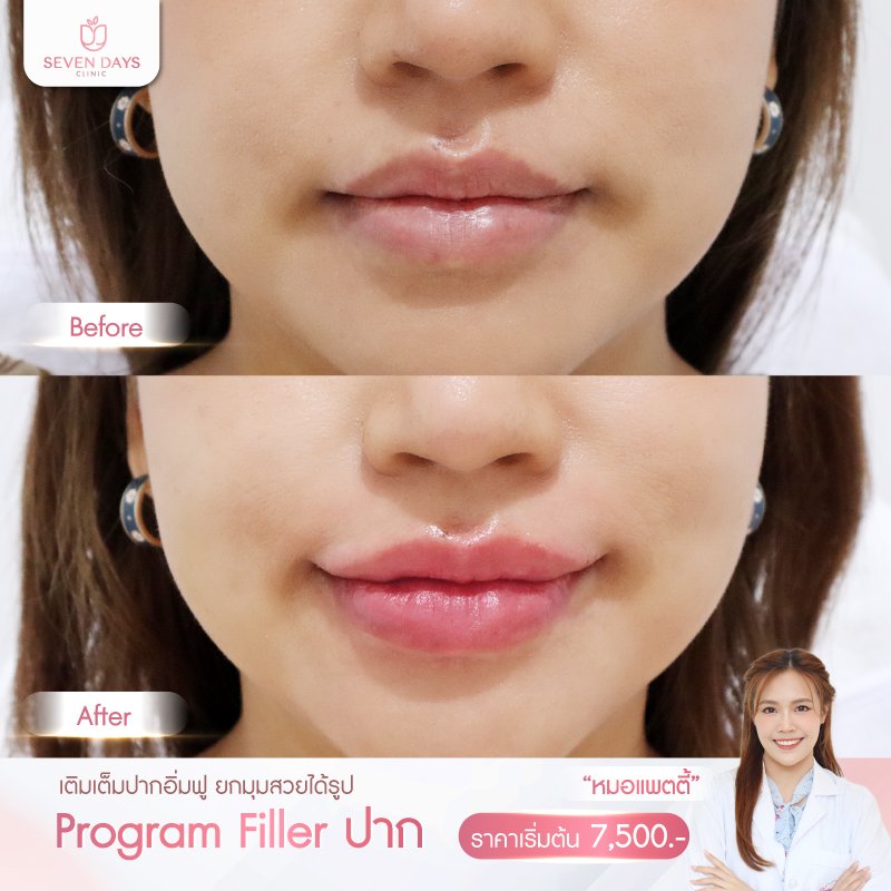 รีวิว Filler