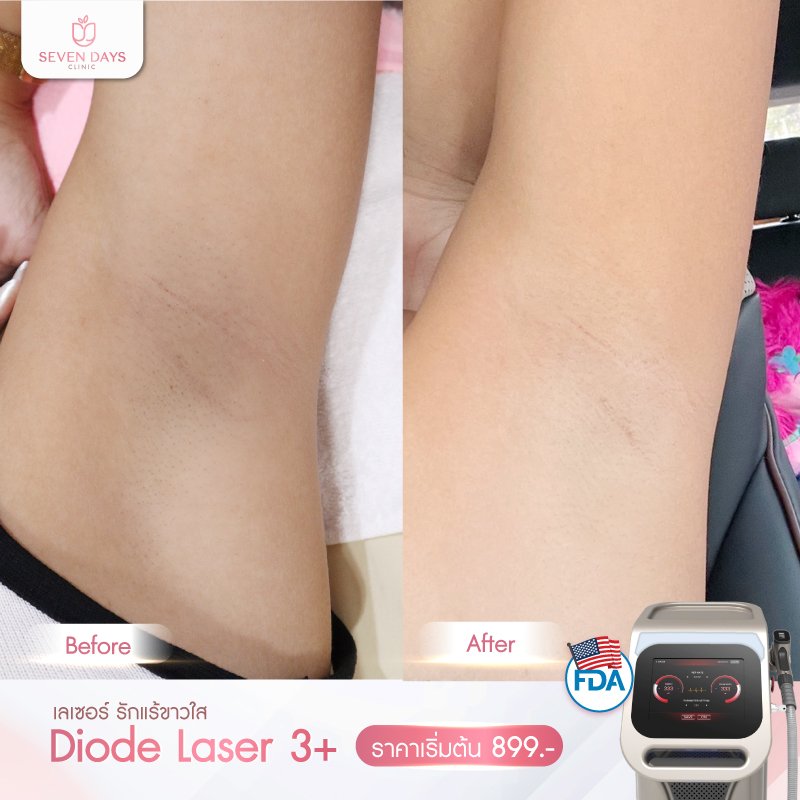 รีวิว Diode Laser กำจัดขน