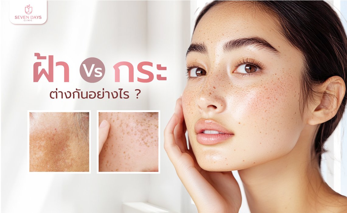 ฝ้า และ กระ ต่างกันอย่างไร
