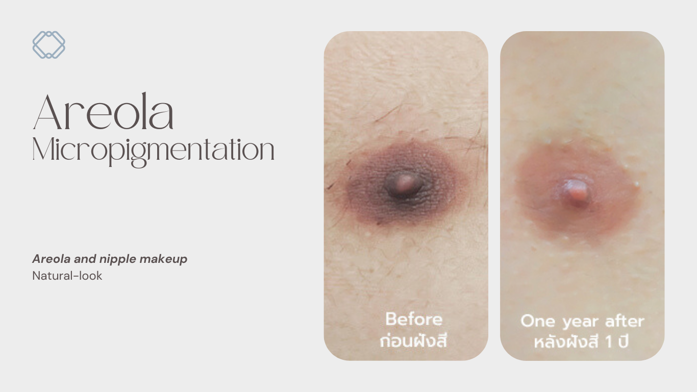 Areola micropigmentation
