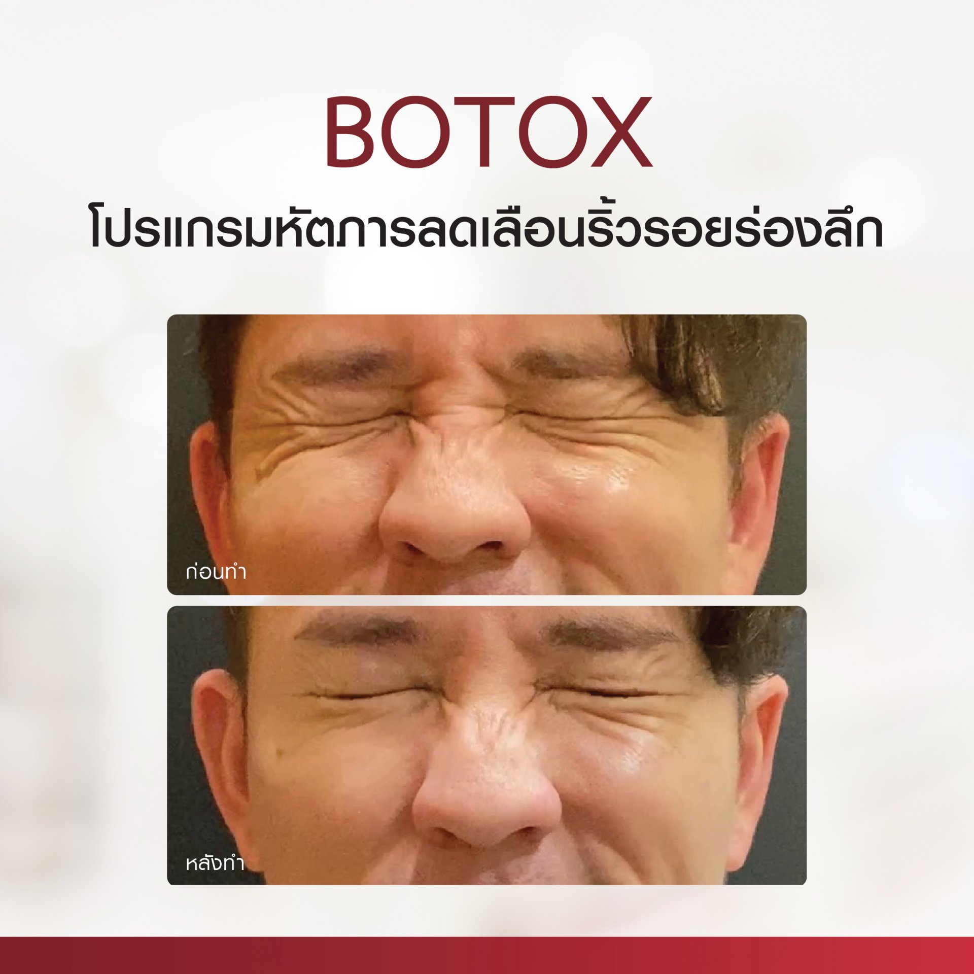 Review Botulinum Toxin