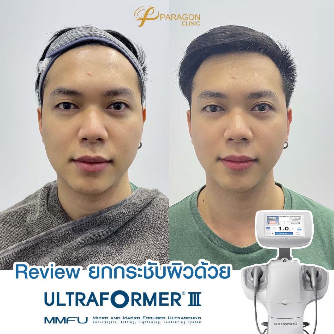 ๊Ultraformer III