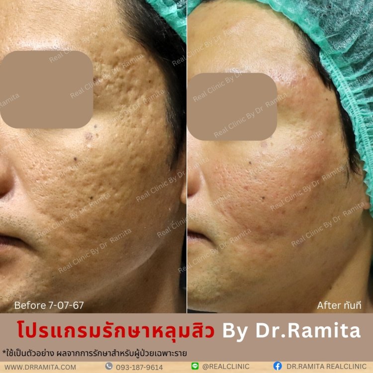 รักษาหลุมสิว,ตัดพังผืด,รักษาหลุมสิว, วิธีรักษาหลุมสิว, Fractional Laser, Microneedling, Subcision, เติมฟิลเลอร์, Real Scar Synergy, Juvgen,acnescarsurgery,acnescarrevision,รักษาหลุมสิวให้ตื้น,เลเซอร์หลุมสิว, รักษาหลุมสิวที่ดีที่สุด,รักษาหลุมสิวให้หายขาด,ห