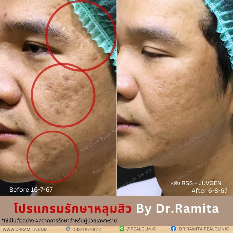 juvgen ดร.จิน หลุมสิวเกาหลี real scar synergy รักษาหลุมสิว