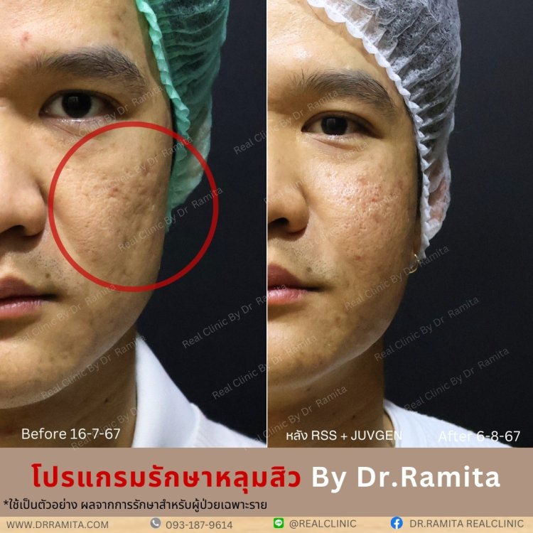 juvgen ดร.จิน หลุมสิวเกาหลี real scar synergy รักษาหลุมสิว