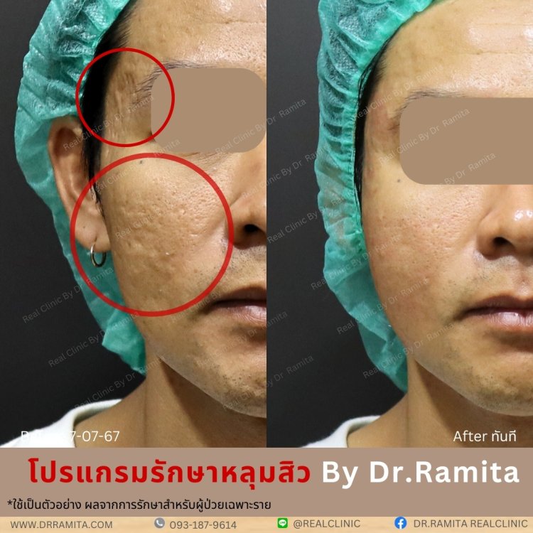 รักษาหลุมสิว,ตัดพังผืด,รักษาหลุมสิว, วิธีรักษาหลุมสิว, Fractional Laser, Microneedling, Subcision, เติมฟิลเลอร์, Real Scar Synergy, Juvgen,acnescarsurgery,acnescarrevision,รักษาหลุมสิวให้ตื้น,เลเซอร์หลุมสิว, รักษาหลุมสิวที่ดีที่สุด,รักษาหลุมสิวให้หายขาด,ห