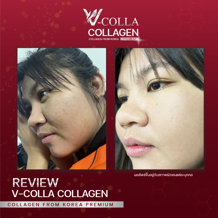 รูขุมขนกว้าง