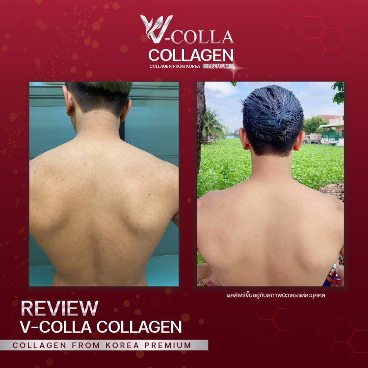 สิวหลัง