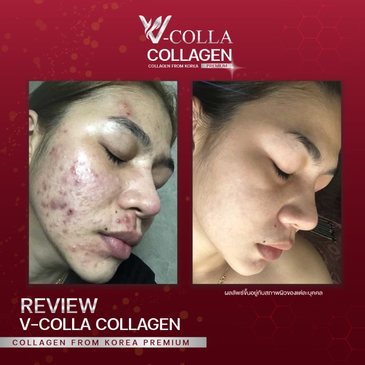 สิวอักเสบ