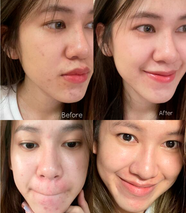 วีด้า เบลล่า ราณี VIDA GlutaMax ผิวขาว สวย กระจ่างใส ลดสิว ลดจุดด่างดำ กลูตาแม็กซ์ กลูต้า บำรุงผิว อาหารเสริม