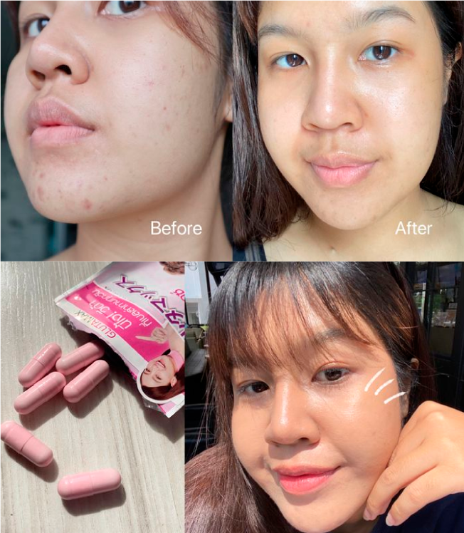 วีด้า เบลล่า ราณี VIDA GlutaMax ผิวขาว สวย กระจ่างใส ลดสิว ลดจุดด่างดำ กลูตาแม็กซ์ กลูต้า บำรุงผิว อาหารเสริม