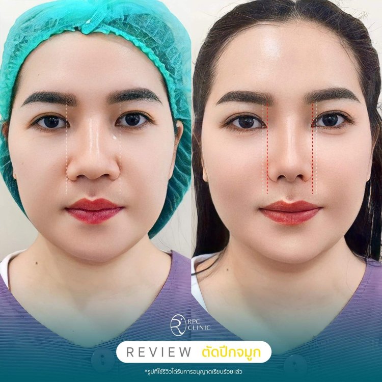 รีวิว ตัดปีกจมูก