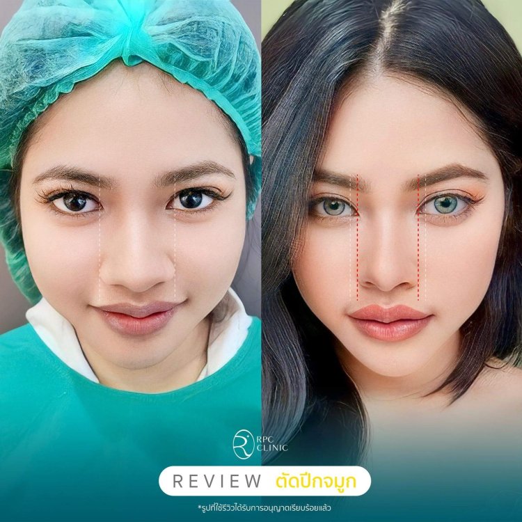 ตัดปีกจมูกคืออะไร