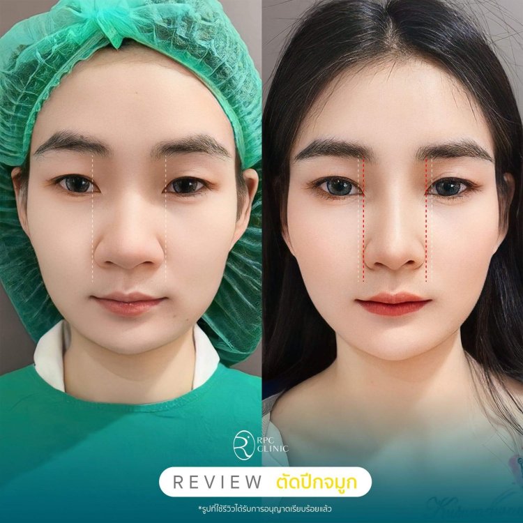 การตัดปีกจมูก