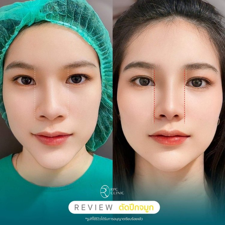  ตัดปีกจมูก Alarplasty