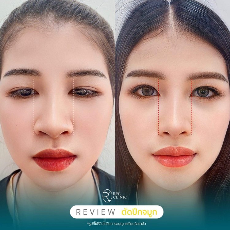  ตัดปีกจมูก รณภีร์คลินิก