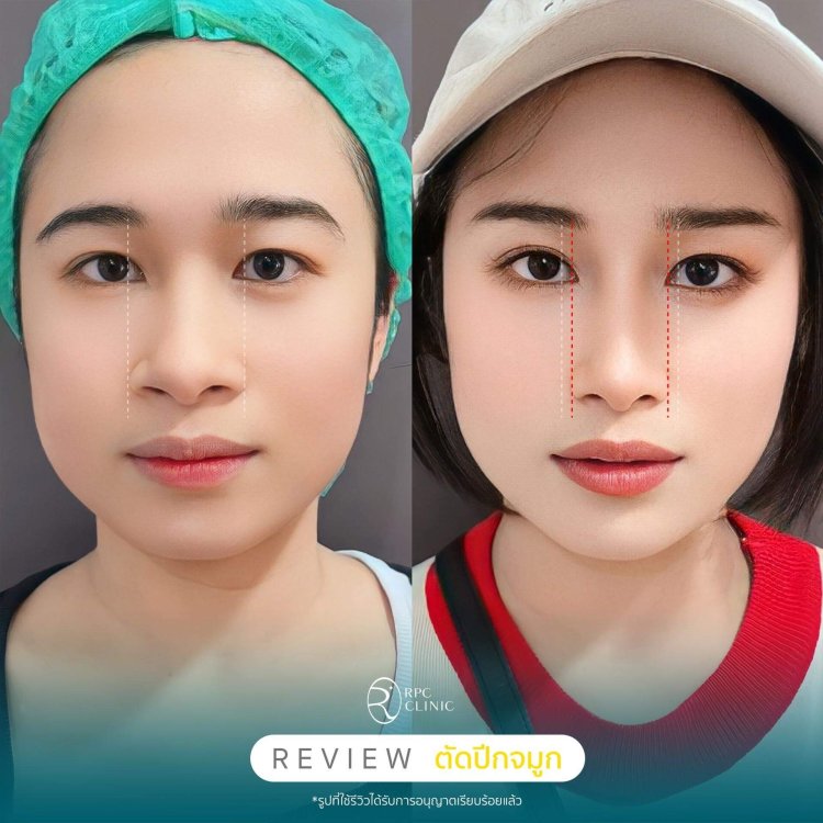  ตัดปีกจมูก Alarplasty