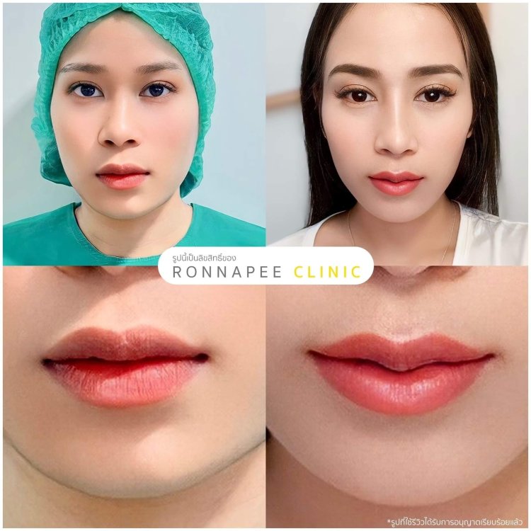 รีวิวหลังทำปากกระจับ