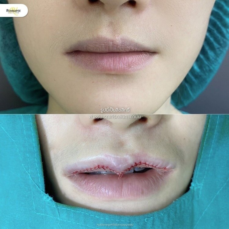  ปากกระจับ