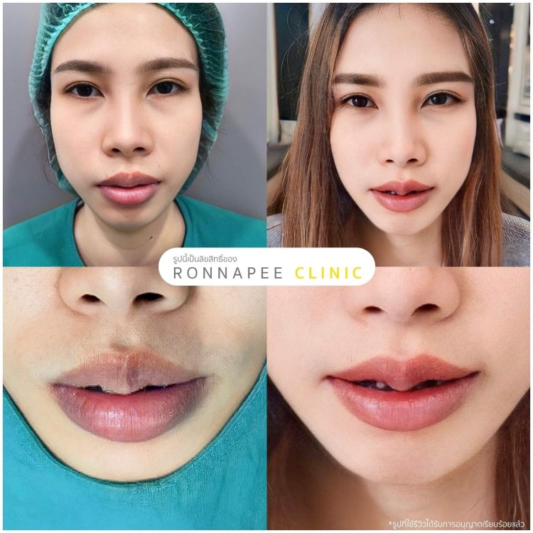 หลังทำ ปากกระจับ