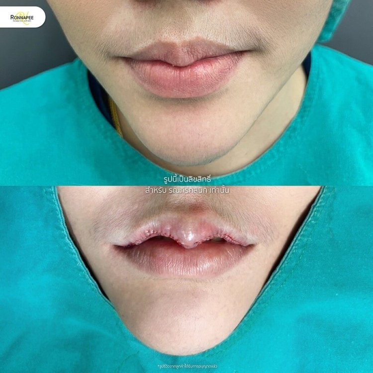 ภาพรีวิวทำปากกระจับ