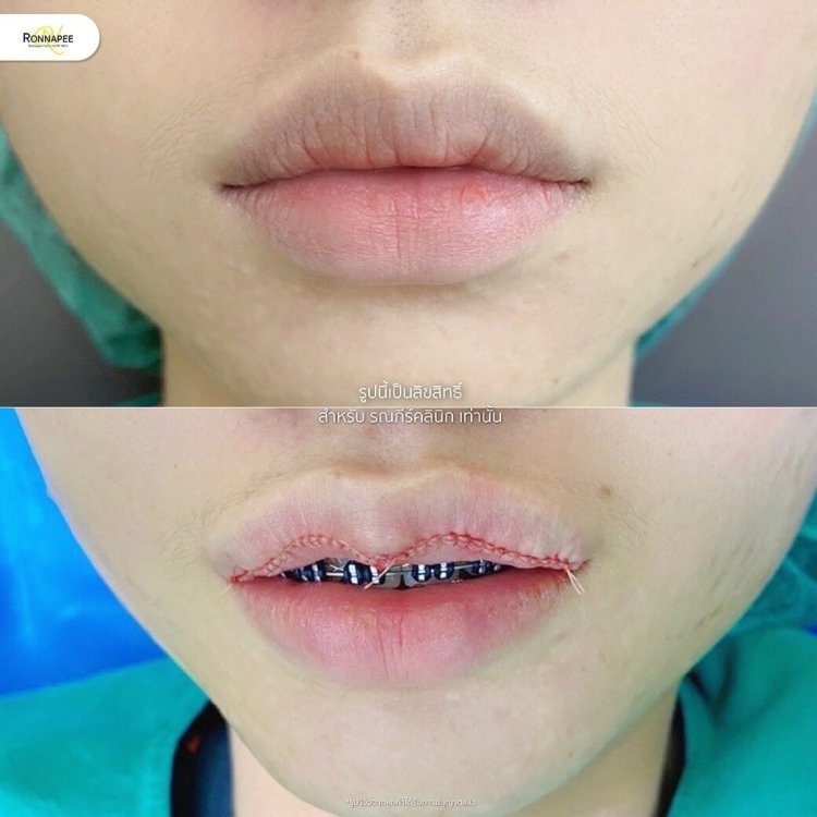 รีวิวทำปากกระจับ RPC