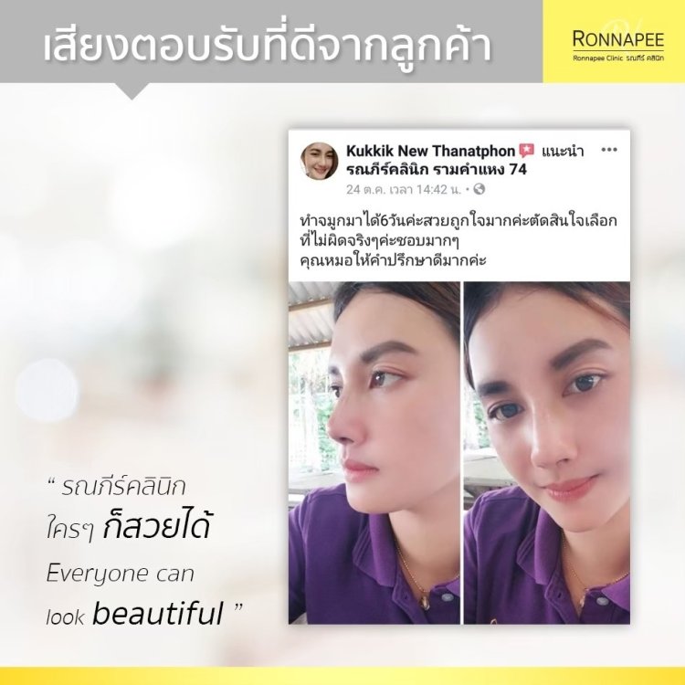 รีวิวเสริมจมูกที่  RonnapeeClinic