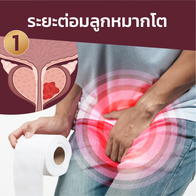 ต่อมลูกหมากโตระยะที่1