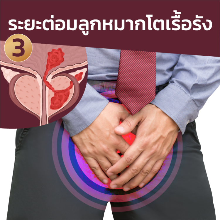 ต่อมลูกหมากโตระยะที่3
