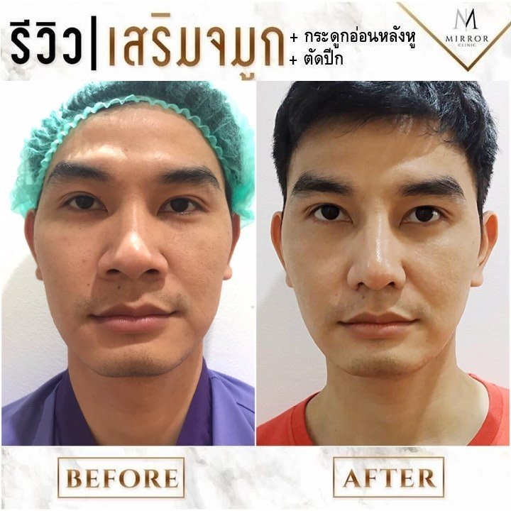 ตัดปีกจมูก