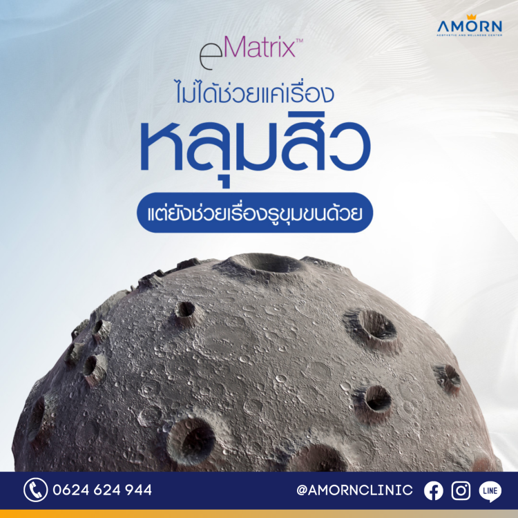 หลุมสิว