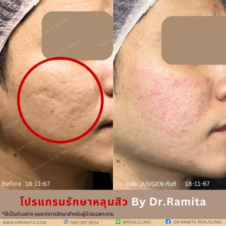 juvgen drjin ดร.จิน หลุมสิวเกาหลี รักษาหลุมสิว ศัลยกรรมหลุมสิว real scar synergy dr ramita  รีวิวหลุมสิว