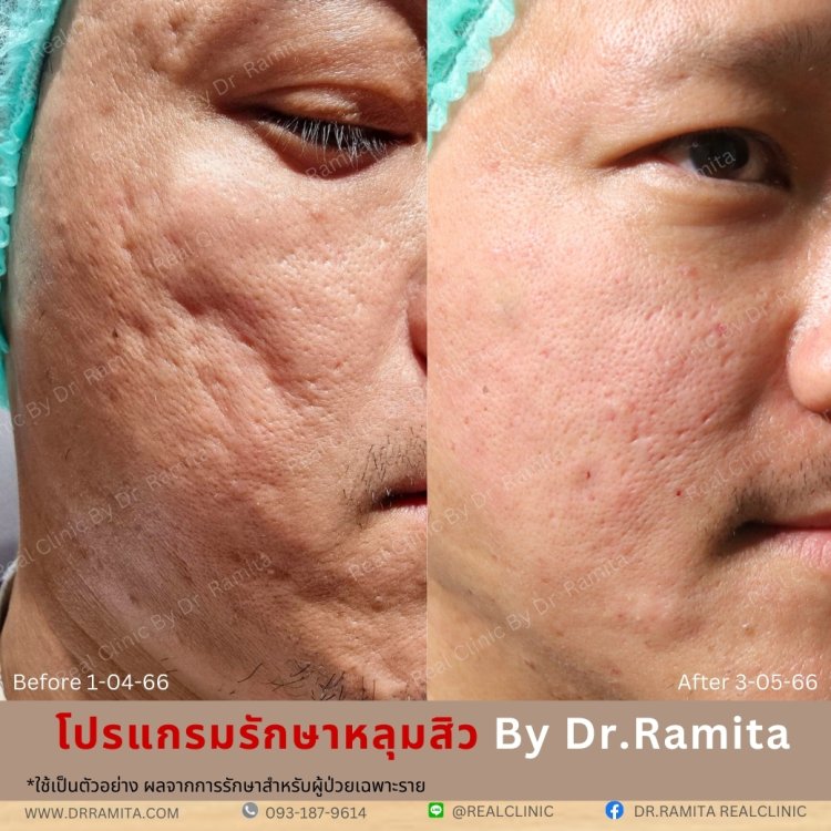 juvgen drjin ดร.จิน หลุมสิวเกาหลี รักษาหลุมสิว ศัลยกรรมหลุมสิว real scar synergy dr ramita 