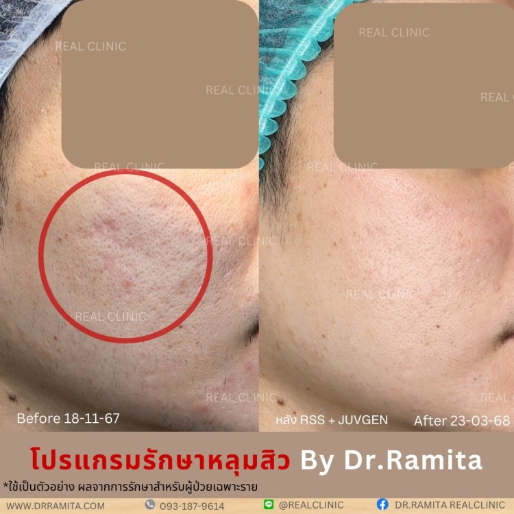 รักษาหลุมสิว,ตัดพังผืด, Subcision  Real Scar Synergy, รักษาหลุมสิวที่ไหนดี,Juvgen,acnescarsurgery,acnescarrevision,รักษาหลุมสิวให้ตื้น,เลเซอร์หลุมสิว, รักษาหลุมสิวที่ดีที่สุด,รักษาหลุมสิวให้หายขาด,หลุมสิว,realclinic , drramita