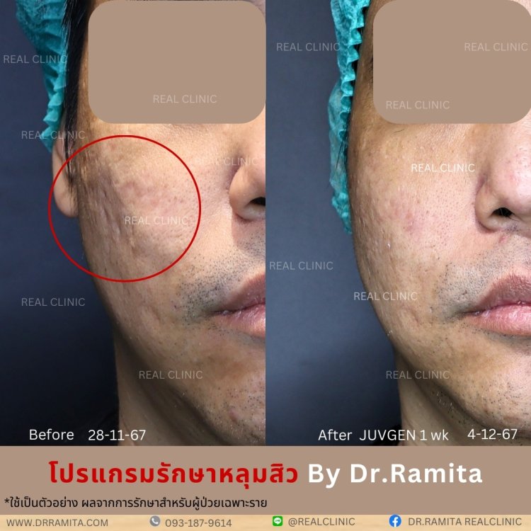 รีวิวหลุมสิว,รักษาหลุมสิว,หลุมสิว,ฟื้นฟูหลุมสิว,juvgen,realclinic