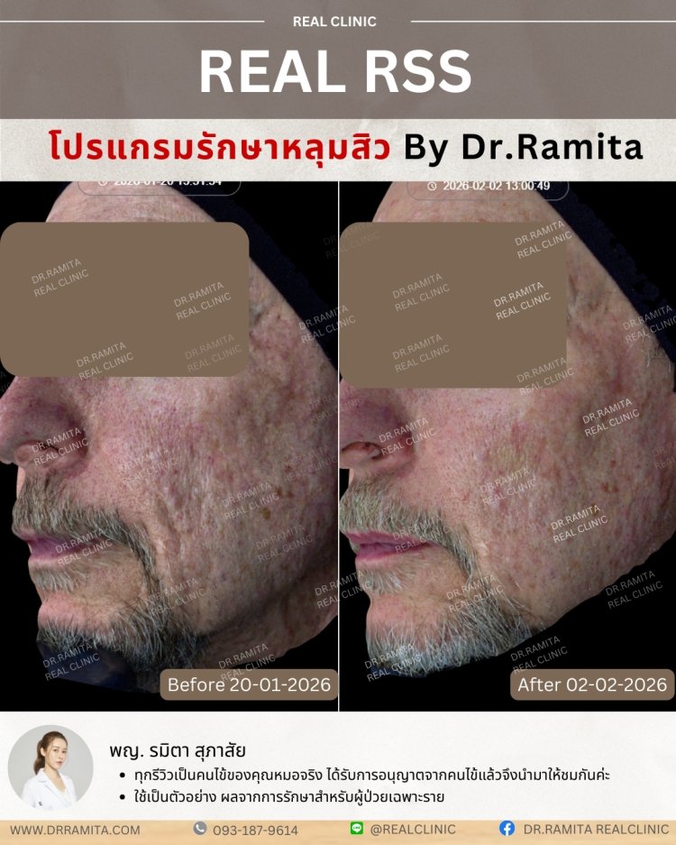 รีวิวหลุมสิว,รักษาหลุมสิว,หลุมสิว,ฟื้นฟูหลุมสิว,juvgen,realclinic