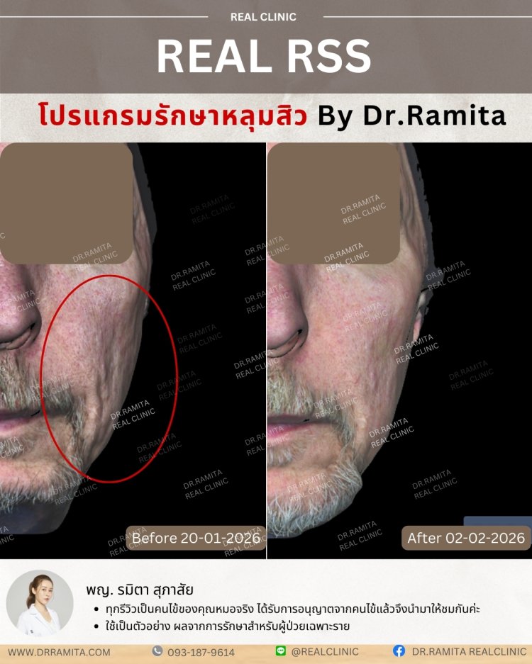 รีวิวหลุมสิว,รักษาหลุมสิว,หลุมสิว,ฟื้นฟูหลุมสิว,juvgen,realclinic