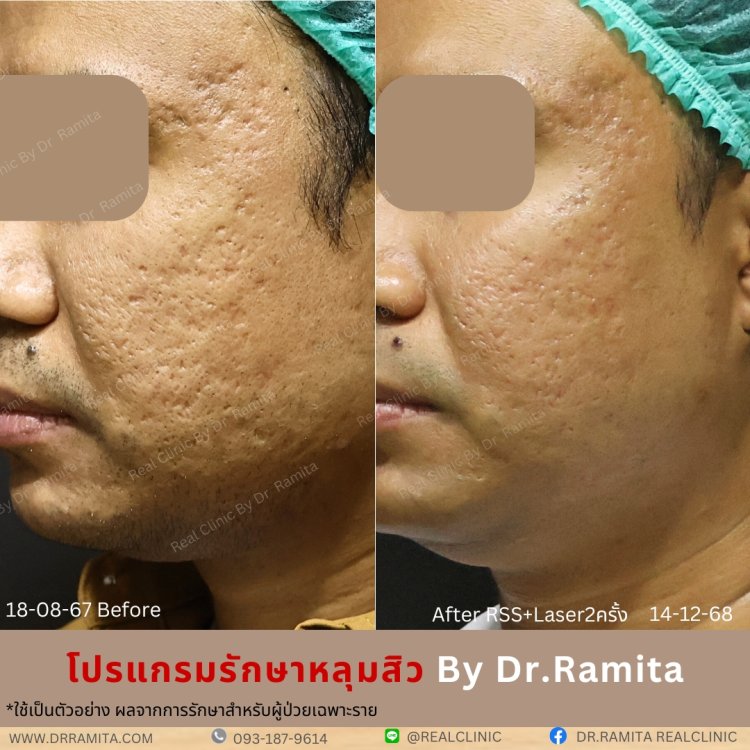 juvgen drjin ดร.จิน หลุมสิวเกาหลี รักษาหลุมสิว ศัลยกรรมหลุมสิว real scar synergy dr ramita  รีวิวหลุมสิว
