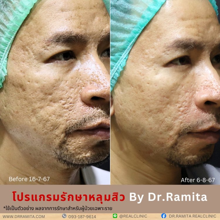 juvgen drjin ดร.จิน หลุมสิวเกาหลี รักษาหลุมสิว ศัลยกรรมหลุมสิว real scar synergy dr ramita  รีวิวหลุมสิว