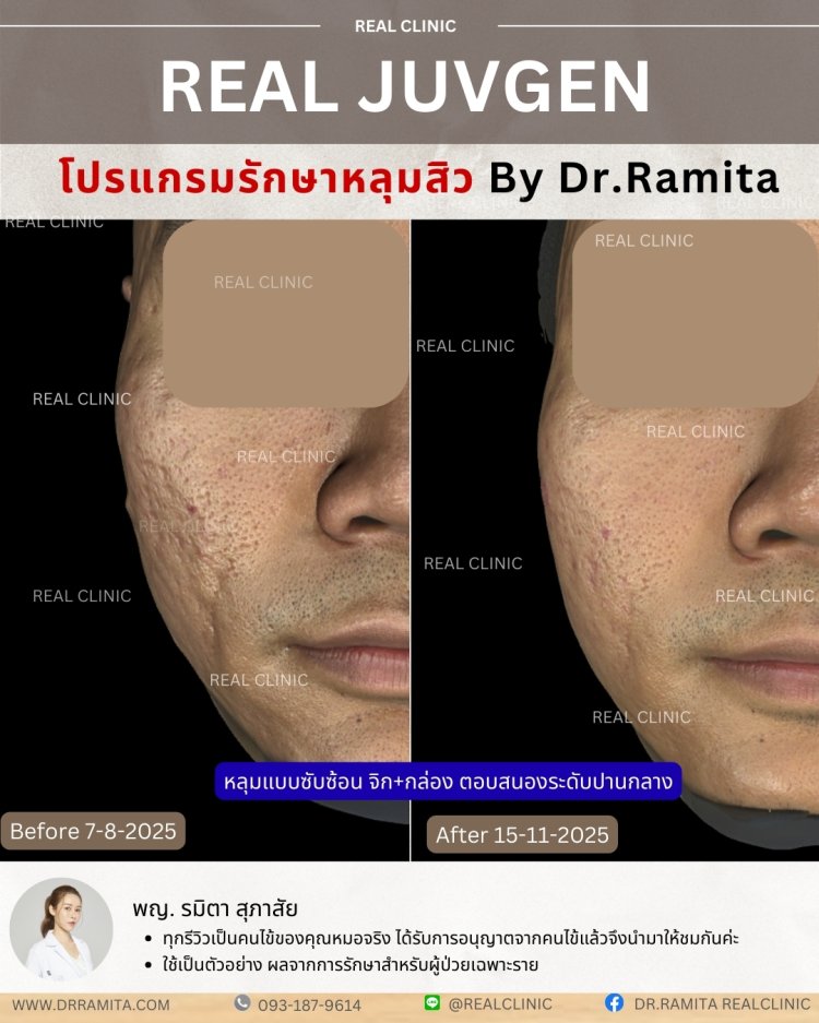 รีวิวหลุมสิว,รักษาหลุมสิว,หลุมสิว,ฟื้นฟูหลุมสิว,juvgen,realclinic
