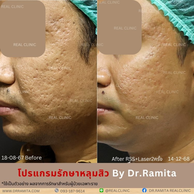 รักษาหลุมสิว,ตัดพังผืด, Subcision  Real Scar Synergy, รักษาหลุมสิวที่ไหนดี,Juvgen,acnescarsurgery,acnescarrevision,รักษาหลุมสิวให้ตื้น,เลเซอร์หลุมสิว, รักษาหลุมสิวที่ดีที่สุด,รักษาหลุมสิวให้หายขาด,หลุมสิว,realclinic , drramita
