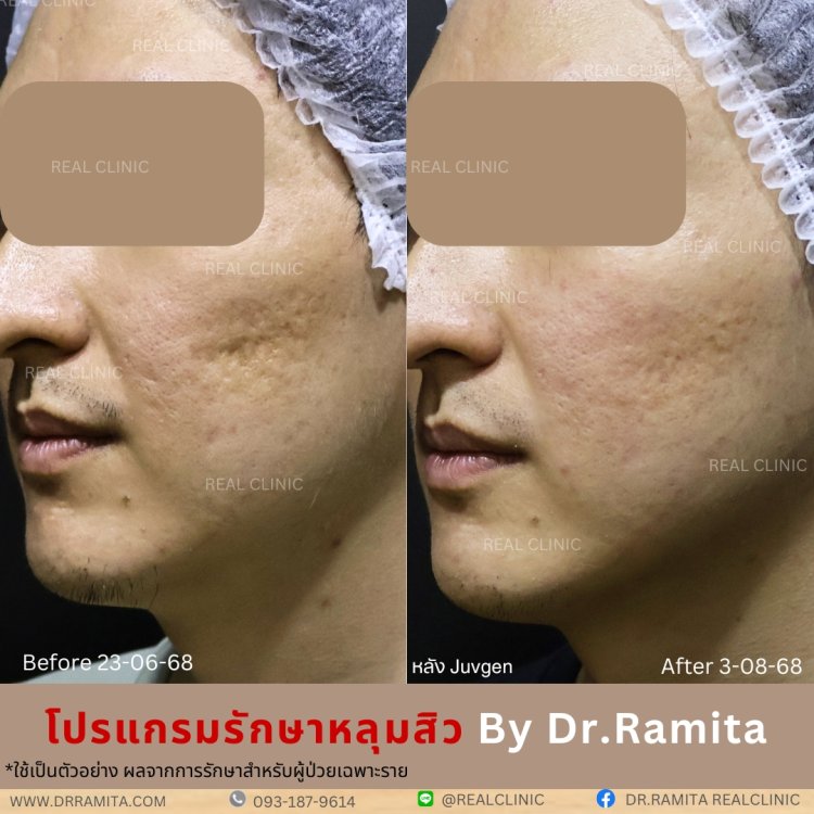 juvgen realclinic รักษาหลุมสิว