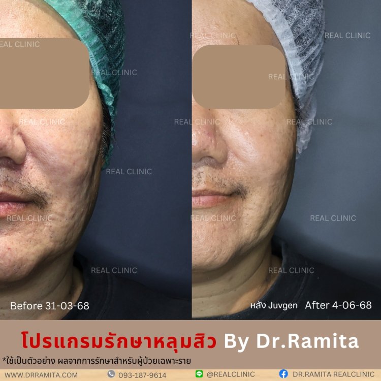 รักษาหลุมสิว,ตัดพังผืด,รักษาหลุมสิว, วิธีรักษาหลุมสิว, Subcision, เติมฟิลเลอร์, Real Scar Synergy, รักษาหลุมสิวที่ไหนดี,Juvgen,acnescarsurgery,acnescarrevision,รักษาหลุมสิวให้ตื้น,เลเซอร์หลุมสิว, รักษาหลุมสิวที่ดีที่สุด,รักษาหลุมสิวให้หายขาด,หลุมสิว,realc