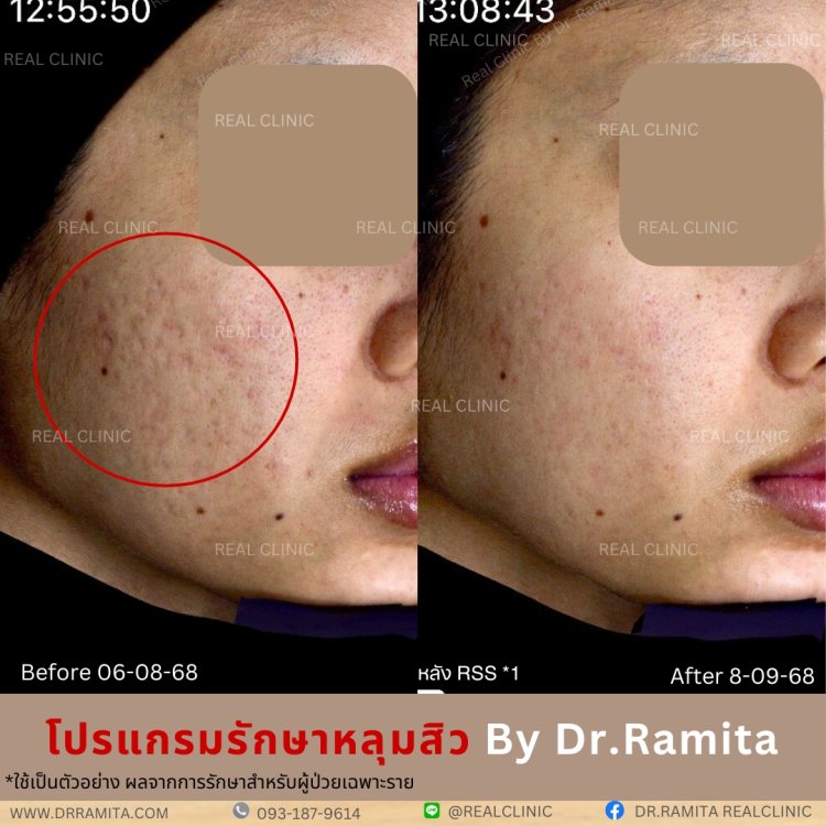 รักษาหลุมสิว,ตัดพังผืด, Subcision  Real Scar Synergy, รักษาหลุมสิวที่ไหนดี,Juvgen,acnescarsurgery,acnescarrevision,รักษาหลุมสิวให้ตื้น,เลเซอร์หลุมสิว, รักษาหลุมสิวที่ดีที่สุด,รักษาหลุมสิวให้หายขาด,หลุมสิว,realclinic , drramita