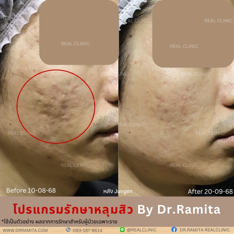 รักษาหลุมสิว,ตัดพังผืด, Subcision  Real Scar Synergy, รักษาหลุมสิวที่ไหนดี,Juvgen,acnescarsurgery,acnescarrevision,รักษาหลุมสิวให้ตื้น,เลเซอร์หลุมสิว, รักษาหลุมสิวที่ดีที่สุด,รักษาหลุมสิวให้หายขาด,หลุมสิว,realclinic , drramita