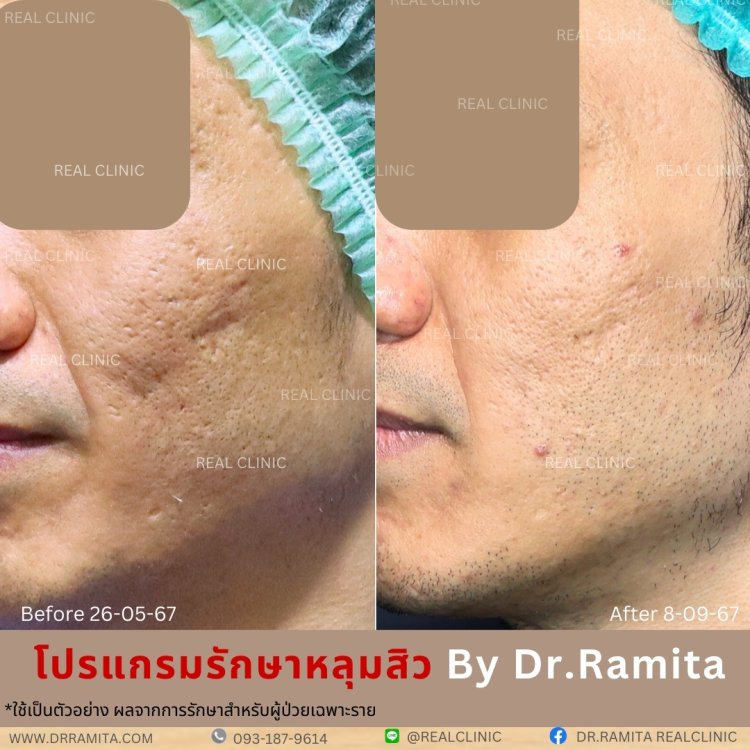 รักษาหลุมสิว,ตัดพังผืด, Subcision  Real Scar Synergy, รักษาหลุมสิวที่ไหนดี,Juvgen,acnescarsurgery,acnescarrevision,รักษาหลุมสิวให้ตื้น,เลเซอร์หลุมสิว, รักษาหลุมสิวที่ดีที่สุด,รักษาหลุมสิวให้หายขาด,หลุมสิว,realclinic , drramita