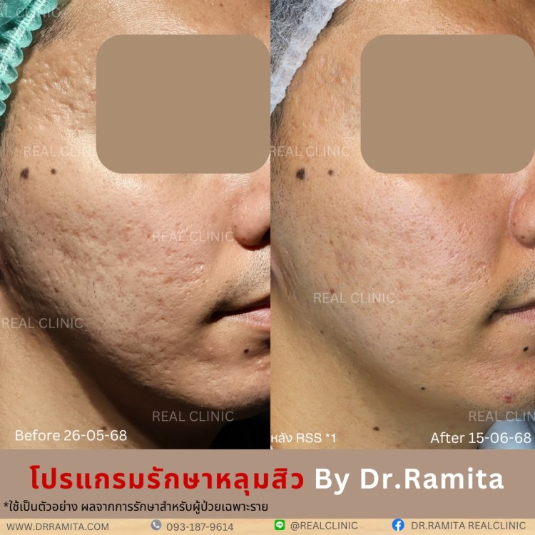 รักษาหลุมสิว,ตัดพังผืด,รักษาหลุมสิว, วิธีรักษาหลุมสิว, Subcision, เติมฟิลเลอร์, Real Scar Synergy, รักษาหลุมสิวที่ไหนดี,Juvgen,acnescarsurgery,acnescarrevision,รักษาหลุมสิวให้ตื้น,เลเซอร์หลุมสิว, รักษาหลุมสิวที่ดีที่สุด,รักษาหลุมสิวให้หายขาด,หลุมสิว,realc